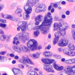 Pleomorphe Tumorzellen